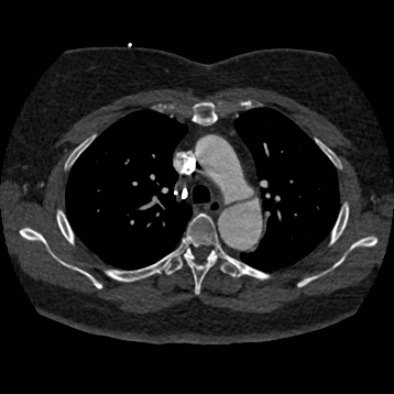 Aortic dissection (Radiopaedia 57969-64959 A 110).jpg