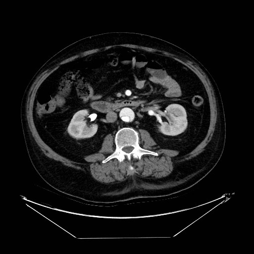 Aortic dissection (Radiopaedia 62562-71000 A 67).jpg