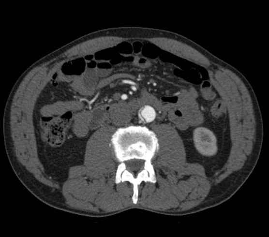 Aortic dissection - Stanford type B (Radiopaedia 73648-84437 A 166).jpg