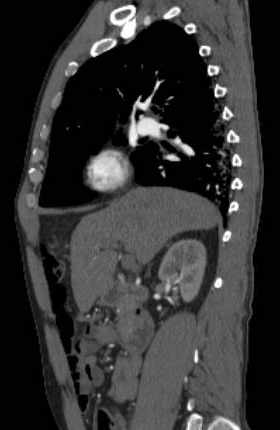 File:Aortic dissection - Stanford type B (Radiopaedia 73648-84437 C 100).jpg