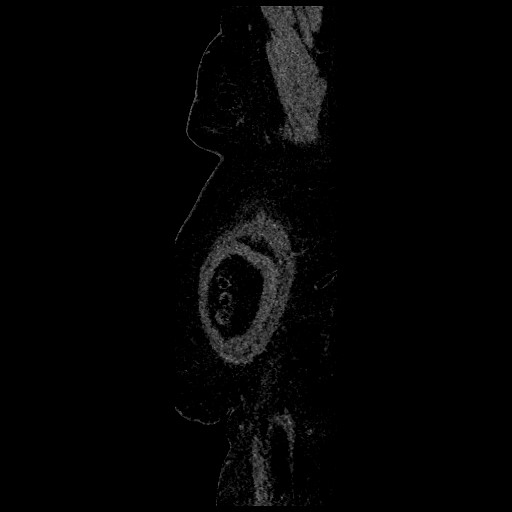 Aortic dissection - Stanford type B (Radiopaedia 88281-104910 C 1).jpg