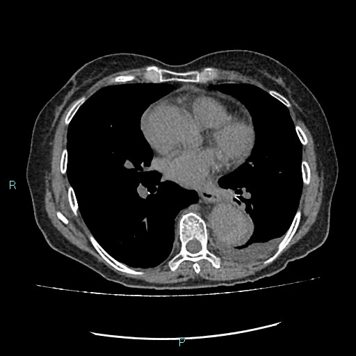 File:Aortic dissection extended to lusory artery (Radiopaedia 43686-47136 Axial non-contrast 17).jpg