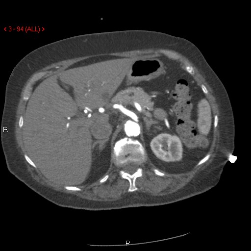 Aortic intramural hematoma (Radiopaedia 27746-28001 A 94).jpg