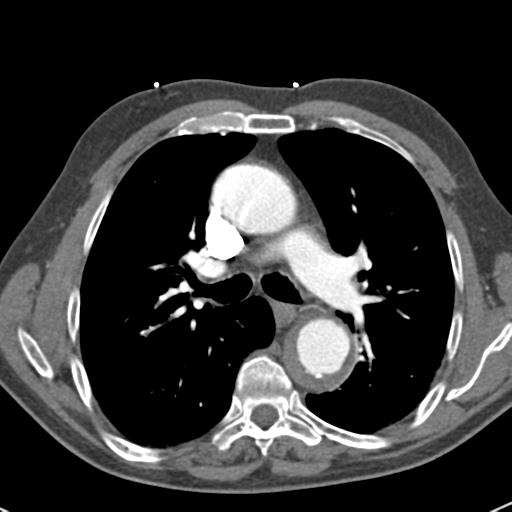 File:Aortic intramural hematoma (Radiopaedia 31139-31838 B 37).jpg