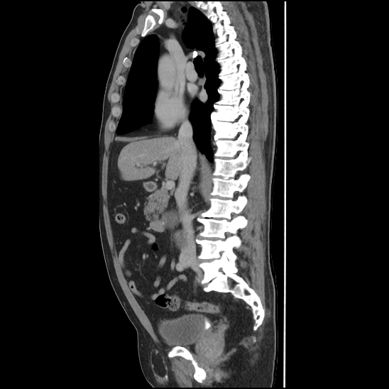 Aortic intramural hematoma (type B) (Radiopaedia 79323-92387 Sagittal C+ delayed 21).jpg