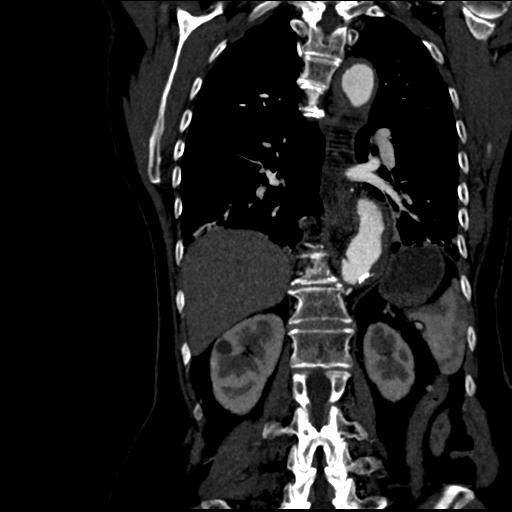 File:Aortic intramural hematoma from penetrating atherosclerotic ulcer (Radiopaedia 31137-31836 C 45).jpg