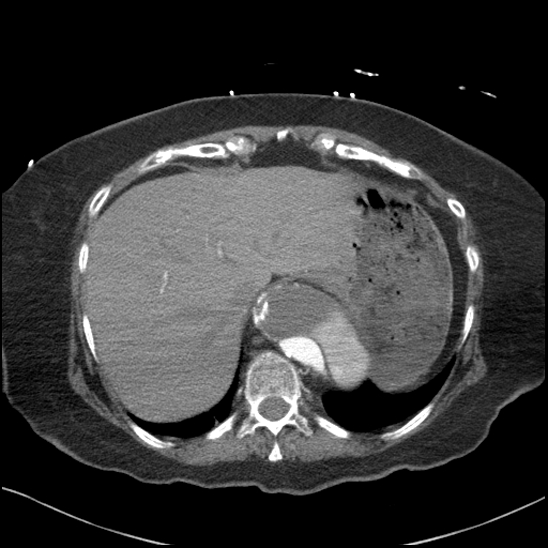 Aortic intramural hematoma with dissection and intramural blood pool (Radiopaedia 77373-89491 B 95).jpg