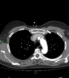 File:Aortic valve endocarditis (Radiopaedia 87209-103485 C 25).jpg
