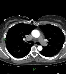 File:Aortic valve endocarditis (Radiopaedia 87209-103485 C 38).jpg