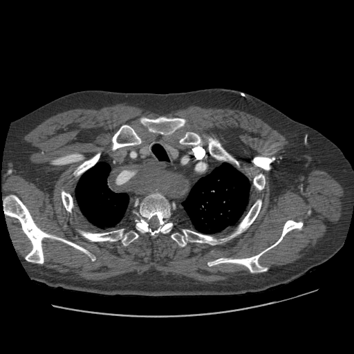 File:Aorto-coronary bypass graft aneurysms (Radiopaedia 40562-43157 A 20).png