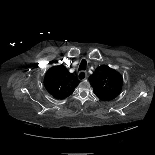 Aortoesophageal fistula with endovascular repair (Radiopaedia 73781-84592 Axial C+ CTPA 11).jpg