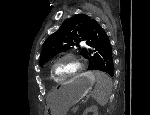 Aortoesophageal fistula with endovascular repair (Radiopaedia 73781-84592 Sagittal C+ CTPA 138).jpg