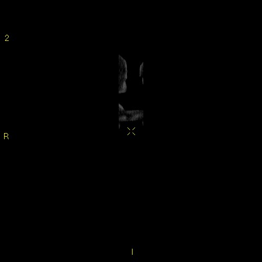 File:Aortoiliac occlusive disease (Radiopaedia 16828-16548 B 1).jpg