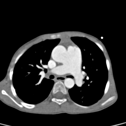 File:Aortopulmonary window, interrupted aortic arch and large PDA giving the descending aorta (Radiopaedia 35573-37074 B 38).jpg