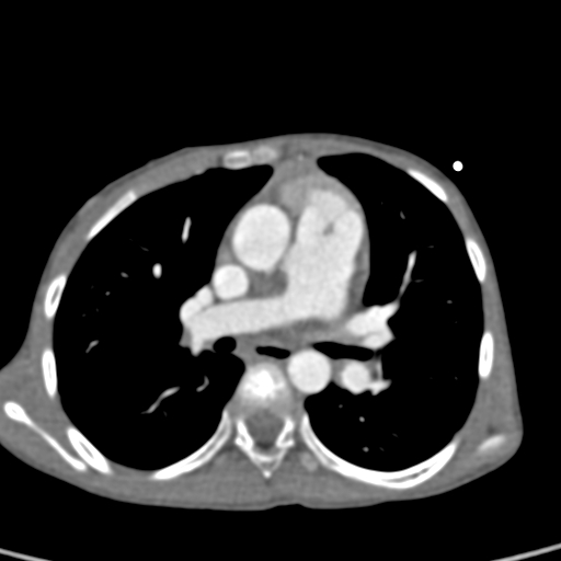 File:Aortopulmonary window, interrupted aortic arch and large PDA giving the descending aorta (Radiopaedia 35573-37074 B 41).jpg