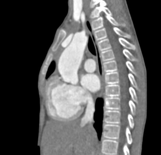 File:Aortopulmonary window, interrupted aortic arch and large PDA giving the descending aorta (Radiopaedia 35573-37074 C 13).jpg