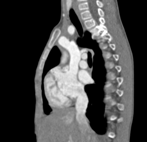 File:Aortopulmonary window, interrupted aortic arch and large PDA giving the descending aorta (Radiopaedia 35573-37074 C 6).jpg