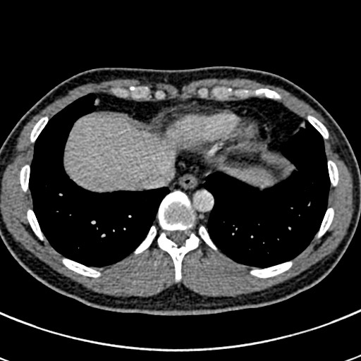 File:Apical lung mass mimic - neurogenic tumor (Radiopaedia 59918-67521 A 65).jpg