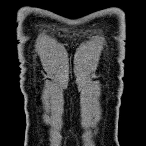 Apical lung mass mimic - neurogenic tumor (Radiopaedia 59918-67521 B 105).jpg