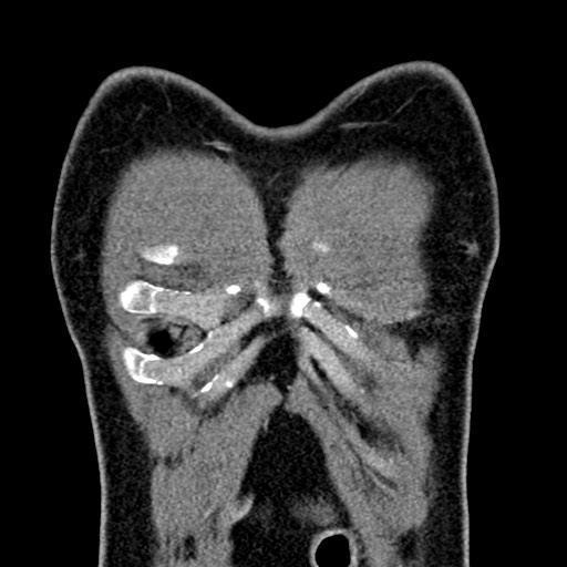 Apical lung mass mimic - neurogenic tumor (Radiopaedia 59918-67521 B 32).jpg
