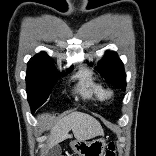 Apical lung mass mimic - neurogenic tumor (Radiopaedia 59918-67521 B 38).jpg