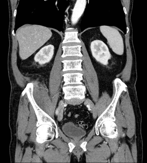 Appendiceal adenocarcinoma complicated by retroperitoneal abscess (Radiopaedia 58007-65039 A 56).jpg