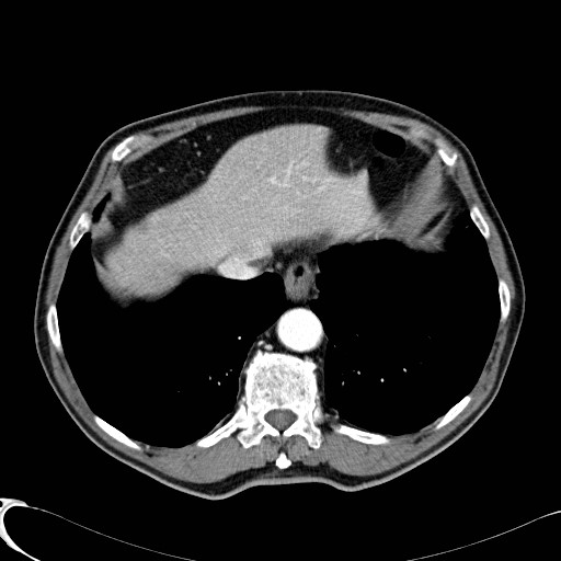 File:Appendiceal adenocarcinoma complicated by retroperitoneal abscess (Radiopaedia 58007-65039 B 18).jpg