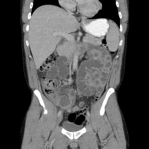 Appendicitis complicated by post-operative collection (Radiopaedia 35595-37114 B 25).jpg
