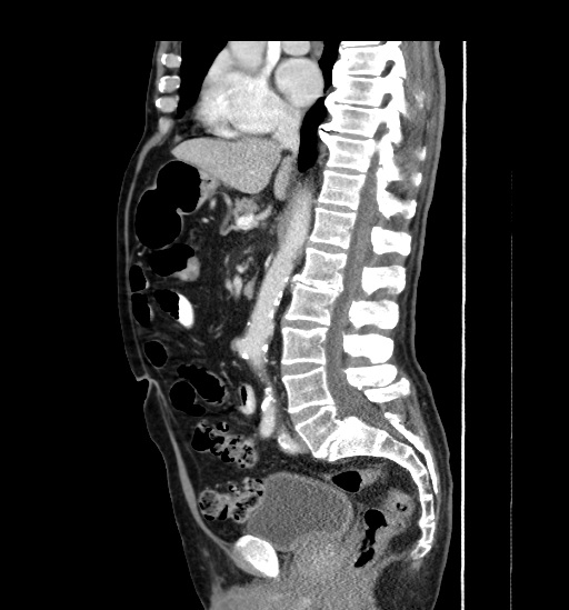 Appendicitis with localized perforation and abscess formation (Radiopaedia 49035-54130 C 32).jpg