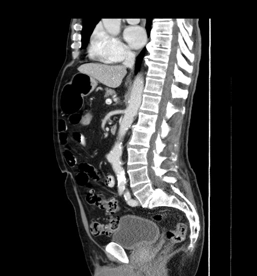 Appendicitis with localized perforation and abscess formation (Radiopaedia 49035-54130 C 33).jpg