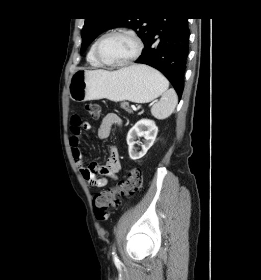 Appendicitis with localized perforation and abscess formation (Radiopaedia 49035-54130 C 48).jpg