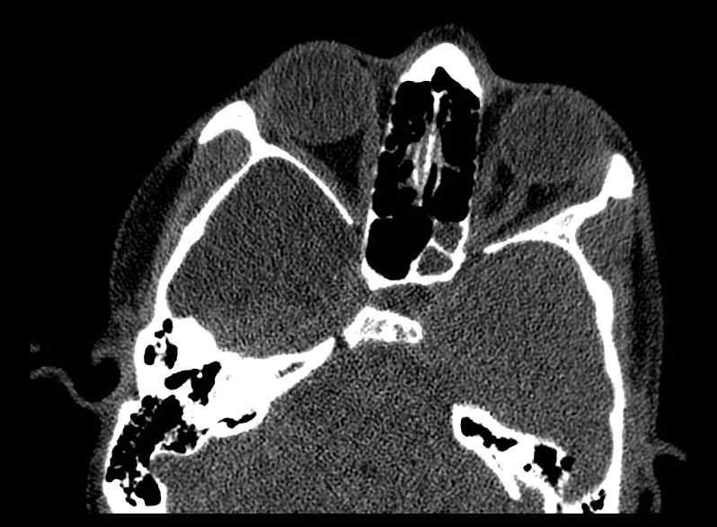 Arachnoid cyst- extremely large (Radiopaedia 68741-78450 Axial bone window 21).jpg