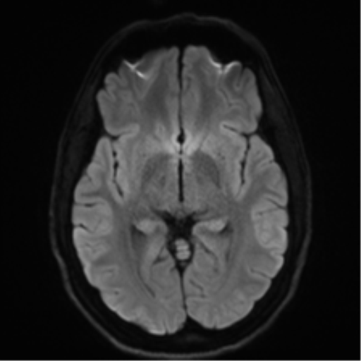 Arachnoid cyst - cerebellopontine angle (Radiopaedia 59689-67083 Axial DWI 53).png