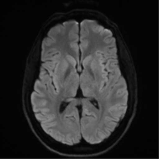 Arachnoid cyst - cerebellopontine angle (Radiopaedia 59689-67083 Axial DWI 55).png