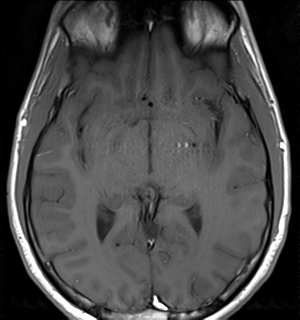File:Arachnoid cyst - cerebellopontine angle (Radiopaedia 59689-67083 Axial T1 22).png