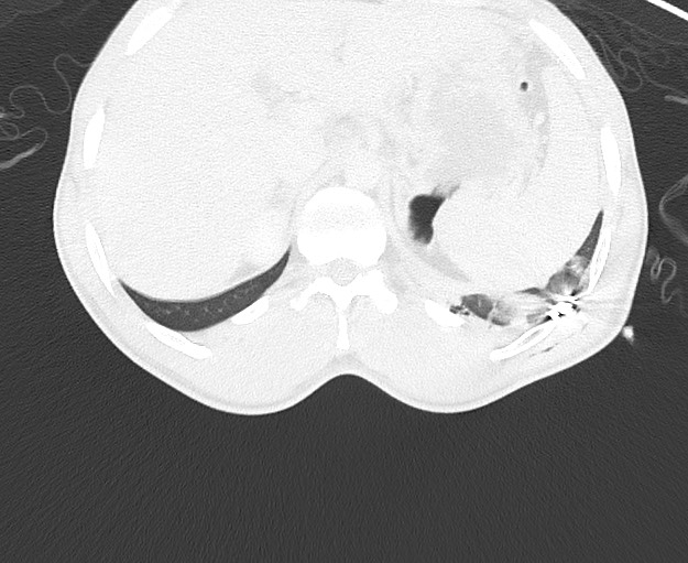 Arrow injury to the chest (Radiopaedia 75223-86321 Axial lung window 101).jpg