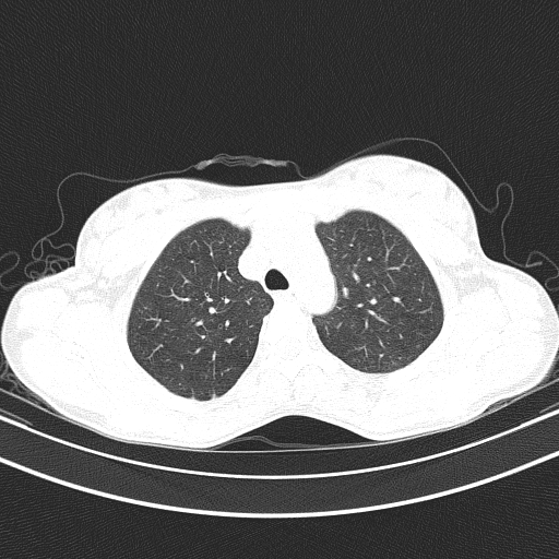 Arteria lusoria (Radiopaedia 88528-105192 Axial lung window 19).jpg