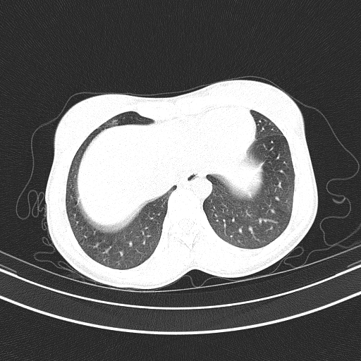 Arteria lusoria (Radiopaedia 88528-105192 Axial lung window 49).jpg