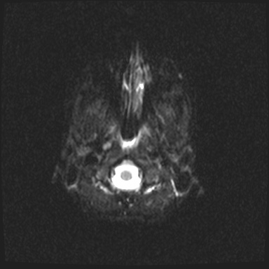 Arteriovenous malformation (Radiopaedia 63693-72385 DWI 1).jpg
