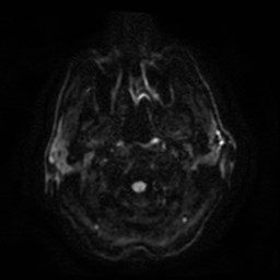 File:Artery of Percheron infarct (Radiopaedia 48088-52928 Axial DWI 2).jpg