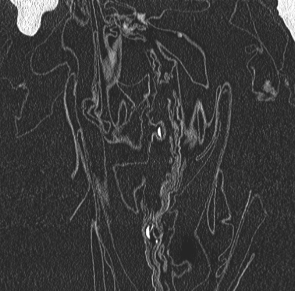 Aspergilloma- with Monod sign (Radiopaedia 44737-48532 Coronal lung window 91).jpg