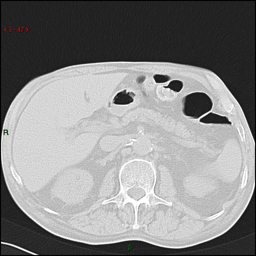 File:Aspergilloma (Radiopaedia 14842-14787 Axial lung window 47).jpg