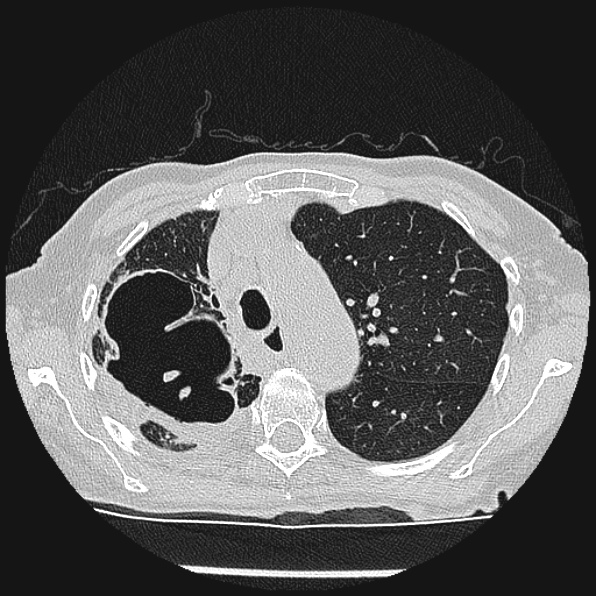 Aspergilloma (Radiopaedia 24458-24763 Axial lung window 18).jpg