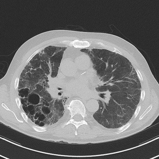 Aspergilloma on background pulmonary fibrosis (Radiopaedia 60942-68757 A 30).jpg