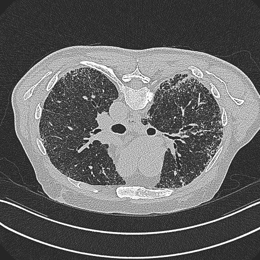 File:Aspergilloma on background pulmonary fibrosis (Radiopaedia 60942-68757 Axial lung window 5).jpg