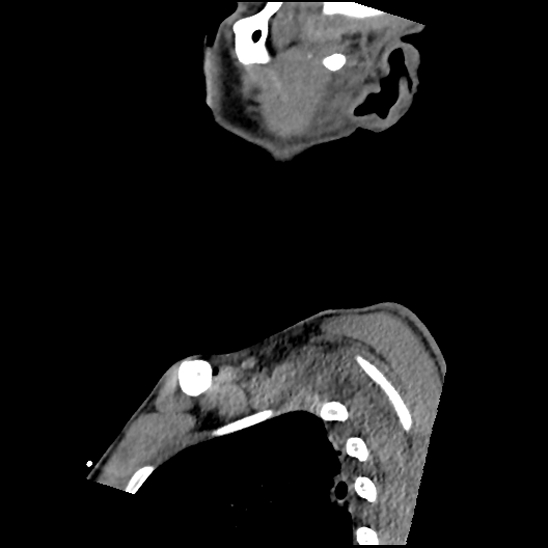 Atlanto-occipital dissociation (Traynelis type 1), C2 teardrop fracture, C6-7 facet joint dislocation (Radiopaedia 87655-104061 D 9).jpg
