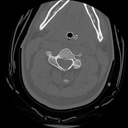 Atlanto-occipital dissociation injury (Radiopaedia 29274-29698 Axial bone window 31).png