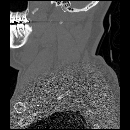 File:Atlanto-occipital dissociation injury (Radiopaedia 29274-29698 Sagittal bone window 9).png