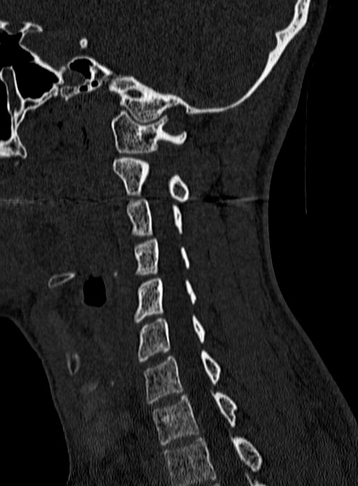 Atlantoaxial subluxation (Radiopaedia 44681-48450 Sagittal bone window 107).jpg