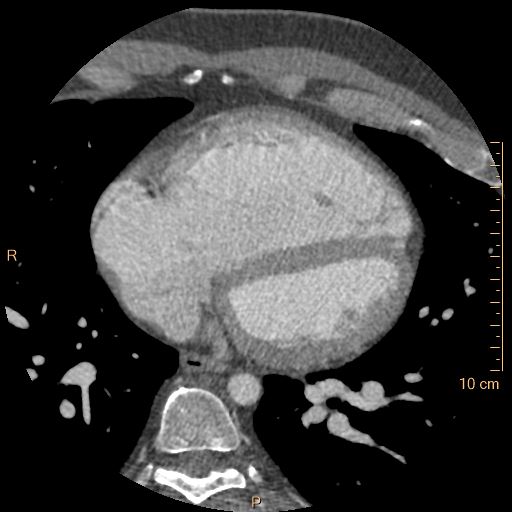 Atrial septal defect (upper sinus venosus type) with partial anomalous pulmonary venous return into superior vena cava (Radiopaedia 73228-83961 A 175).jpg